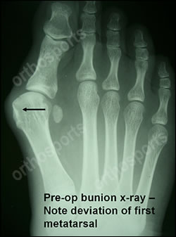 Bunions X Ray