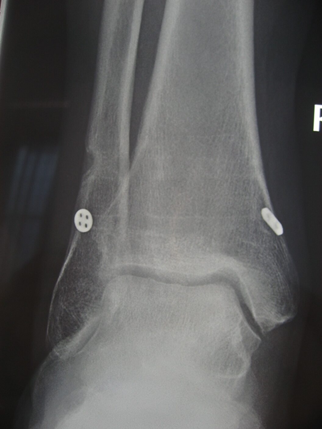 Syndesmosis Fixation Orthosports