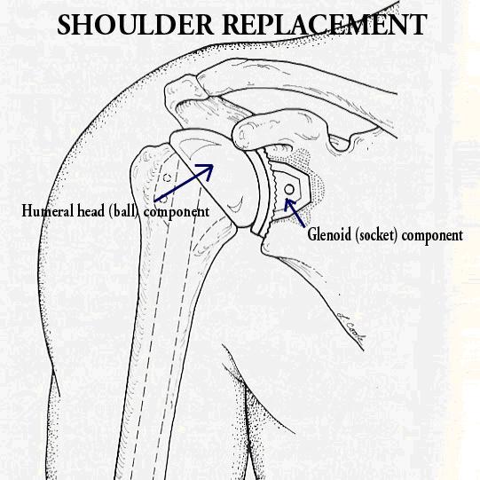 Orthosports Shoulder Replacement