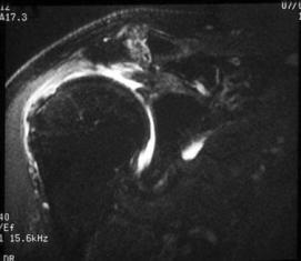 Acromioclavicular Joint Degeneration