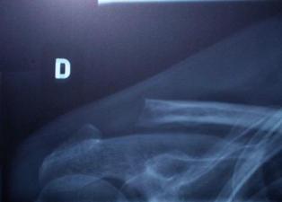 Acromioclavicular Joint Degeneration