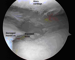 Arthroscopic View