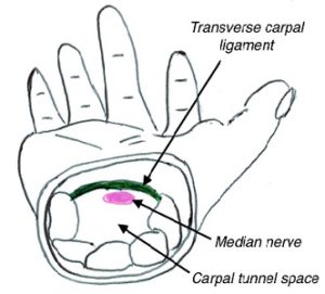 Carpal Tunnel Syndrome, Orthosports Orthopaedic Surgeons