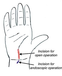 CTS incisions with annotation