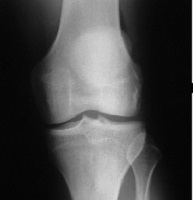 Normal Knee