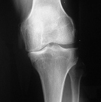 Osteoarthritis