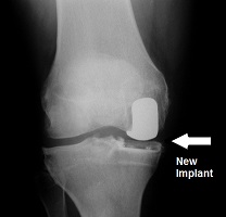 Orthosports Partial Replacement