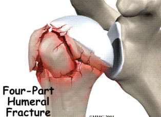 hanging arm cast for humerus fracture