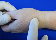 Injury Basal Thumb Education