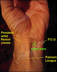 Carpal Tunnel Syndrome Injection