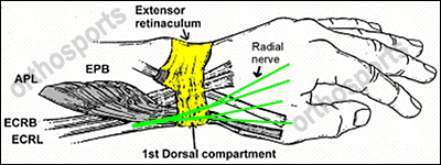 De Quervain's Tenosynovitis Steroid Injection