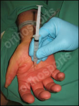 Injury Intermetacarpal Education