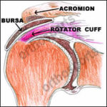 Subacromial Cortisone Injection, Orthosports Orthopaedic Surgeons