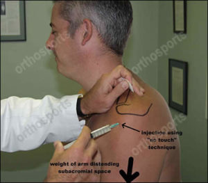 Sasd Injection Subacromial Cortisone Injection, Orthosports Orthopaedic Surgeons