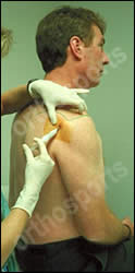 Injury Subacromial Cortisone Education