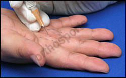 Administration of Trigger Finger Injections, Orthopaedic Surgeons