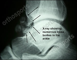 ankle x-ray loose bodies