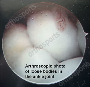 ankle arthroscopic photo loose bodies