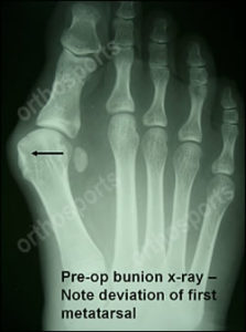 bunionectomy x ray