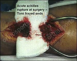 Acute Achilles Tendon Rupture