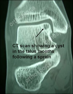 Foot CT Scan - cyst