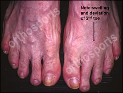 Foot Synovitis