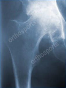 Hip Arthritis