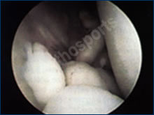 Hip Arthroscopy