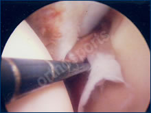 Hip Arthroscopy