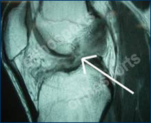 Knee acl
