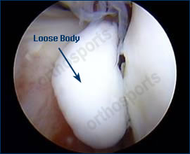 Knee Arthroscopy