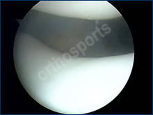 Knee Arthroscopy