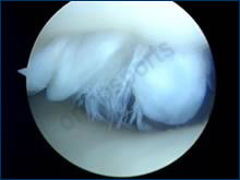 Knee Arthroscopy