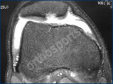 Knee CT