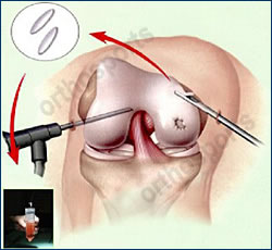 Knee CT