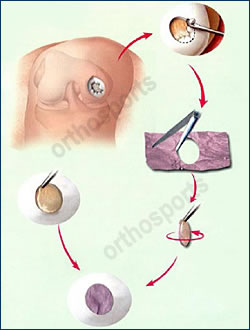 Knee CT