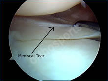 Knee Meniscal Repair