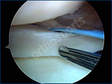 Knee Meniscal Repair