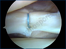 Knee Meniscal Repair