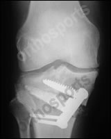 Knee Osteotomy Opening Wedge