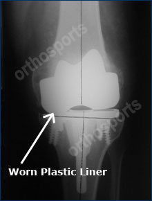 Knee Revision