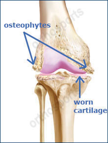 Knee TKR