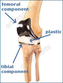 Knee TKR