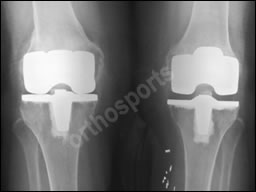 Knee Pain After Total Knee Replacement Orthopaedic Surgeons