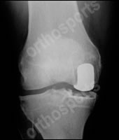 Knee ukr front