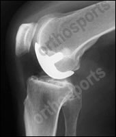 Knee ukr side