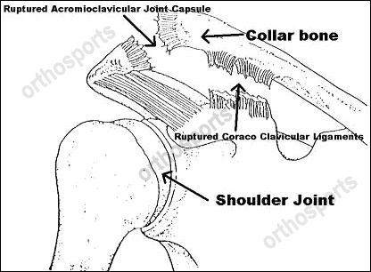 Shoulder Acromio