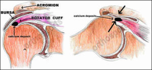 Calcific Tendonitis, Orthosports Orthopaedic Surgeons