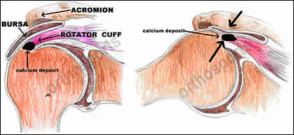 Shoulder Calcific