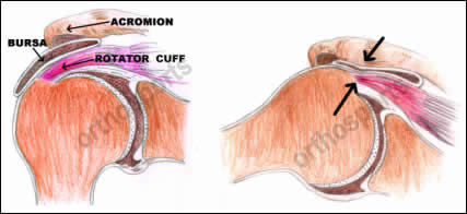 Supraspinatus impingement store